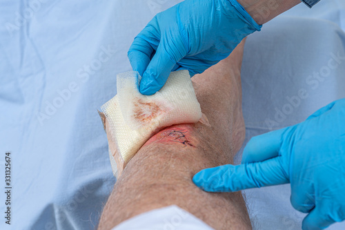 Nurse caring fresh blooded injury wound on the tibial bone of the leg. Sticking stitches to hold the cut.