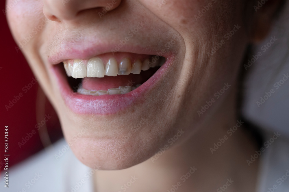 Fototapeta premium Close up photo of an adult woman with dental caries. tooth enamel almost completely erased