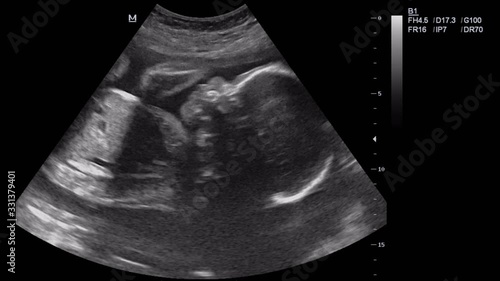 Heart of human embryo on an ultrasound display photo
