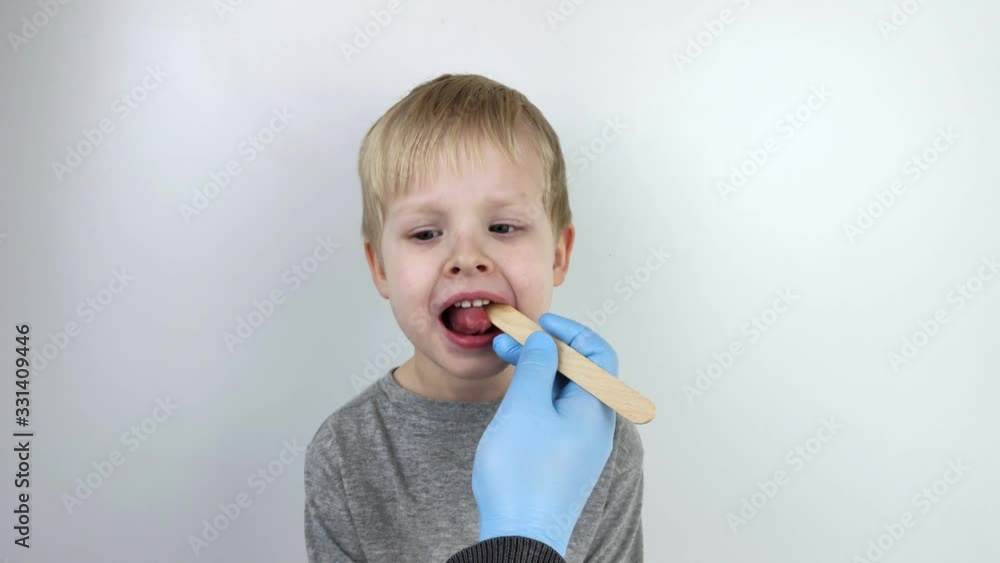 An otolaryngologist examines a child's throat with a wooden spatula. A possible diagnosis is inflammation of the pharynx, tonsils or pharyngitis. An otolaryngologist examines a child's throat with a wooden spatula. A possible diagnosis is inflammation of the pharynx, tonsils or pharyngitis.