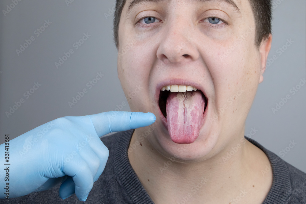 White curd on the tongue. A physician or gastroenterologist examines a
