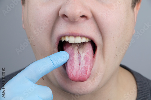 White curd on the tongue. A physician or gastroenterologist examines a man’s tongue. Patient has poor oral hygiene or a symptom of illness photo