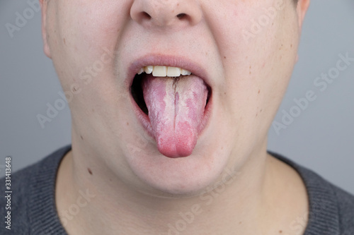 White curd on the tongue. A physician or gastroenterologist examines a man’s tongue. Patient has poor oral hygiene or a symptom of illness