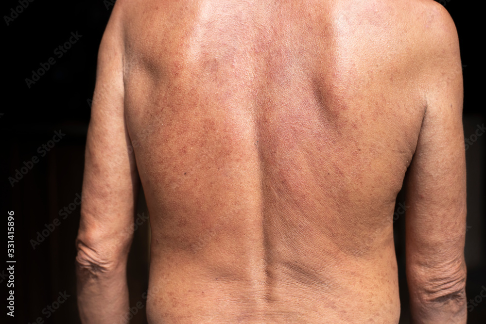 Fototapeta premium Problem skin rash from allergy symptoms.