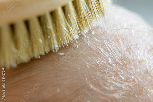Cradle cap on a newborn child head. Parent brushing head of a child because of a cradle cap. 