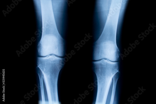 X-ray of human knees, closeup © cunaplus