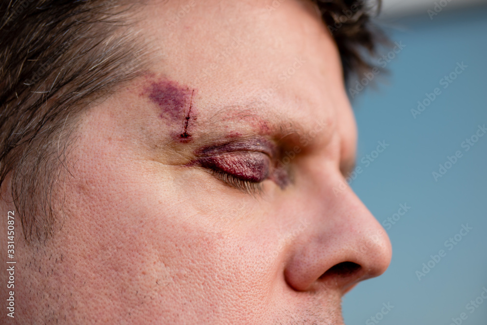 A white man with a purple black eye and head injury - eyes closed, side view A white man with a purple black eye and head injury - eyes closed, side view