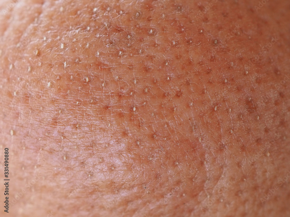 © jaojormami - pimple on the chin in woman cause of oily skin and large pore using for skincare and cleansing or beauty product concept.