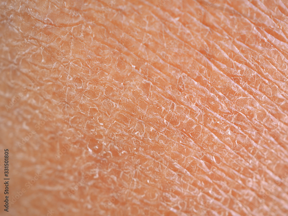dry skin or ichthyosis texture detail in women using for moisturizer lotion, cream or beauty product concept, motion blur and macro shot photo. dry skin or ichthyosis texture detail in women using for moisturizer lotion, cream or beauty product concept, motion blur and macro shot photo.
