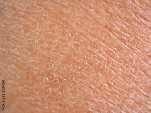 dry skin or ichthyosis texture detail in women using for moisturizer lotion, cream or beauty product concept, motion blur and macro shot photo.