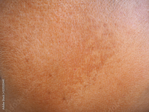 Blemish and freckles on face in asian woman more than thirty year old cause of ultraviolet (UV) or blue light using for sunscreen cream,gel and skincare or beauty product concept.