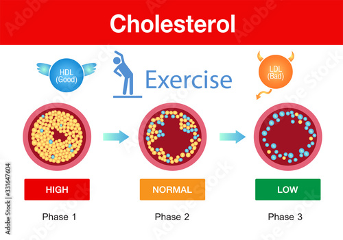 Cholesterol in artery, health risk ,exercise, vector design