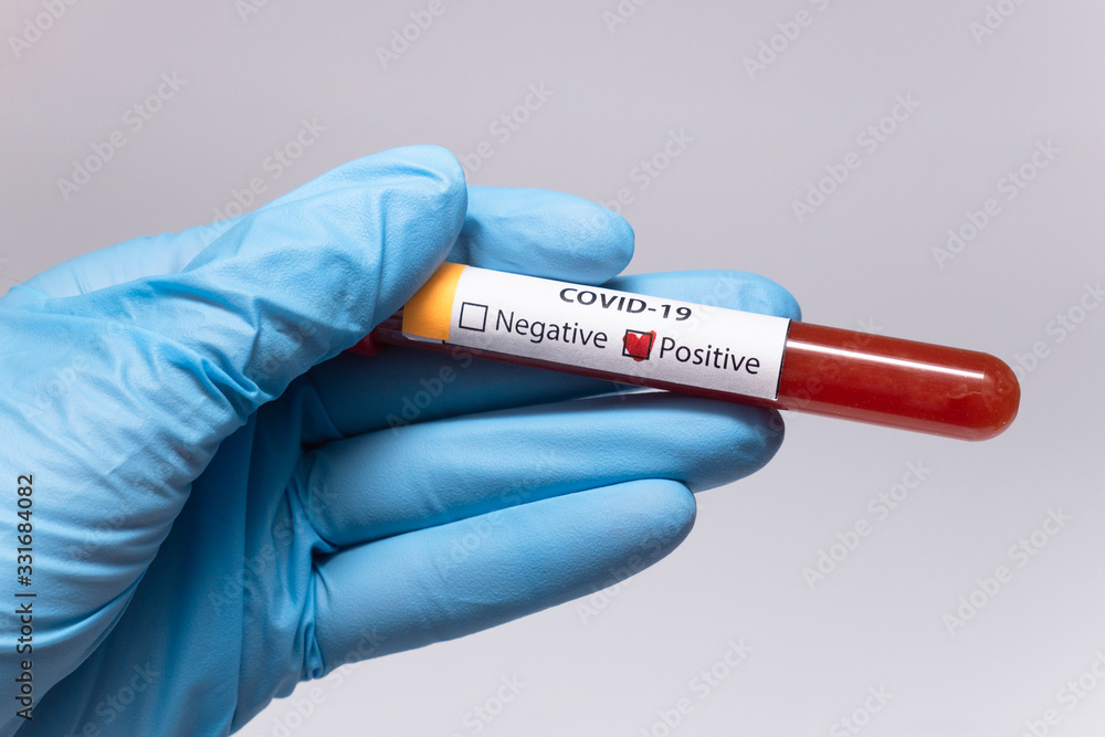 Obraz premium Blood positive test to coronavirus. Medical reseach, test-tube with blood, hand in latex medical gloves. Coronavirus outbreak and influenza. 2019-nCoV, covid-19, sars. High quality photo.