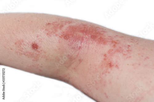 Konstfotografi Eczema on the elbow