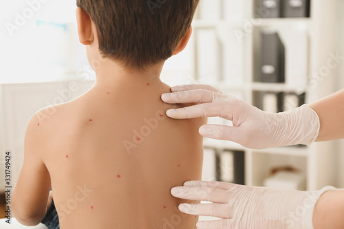 Fotografie Doctor examining little boy with chickenpox in clinic, closeup