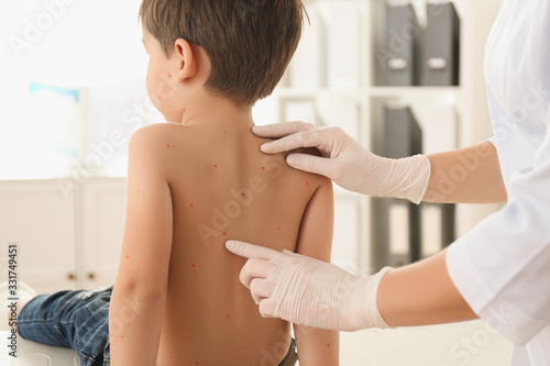 Obraz na plátně Doctor examining little boy with chickenpox in clinic, closeup
