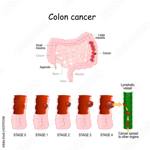 colon cancer. Colorectal oncology. Stages of Development a malignant tumor photo