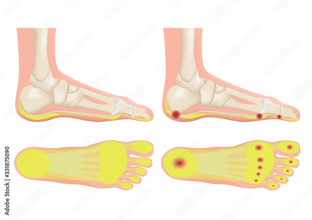 normal foot and a foot with a fat pad atrophy / callus