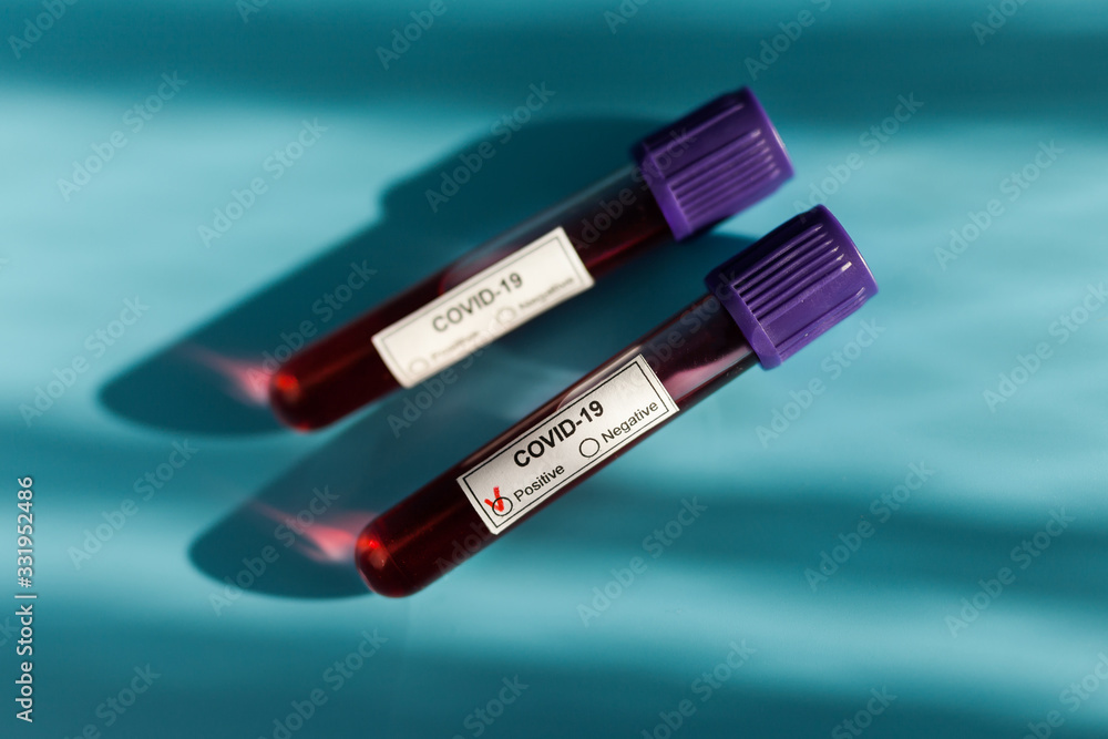 Obraz premium Positive blood test result for the new rapidly spreading Coronavirus