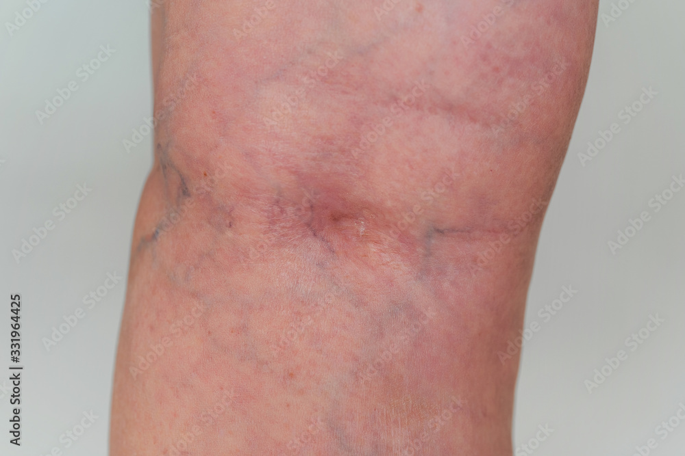 Varicose veins in an elderly woman. Inflamed dilated veins in the legs ...