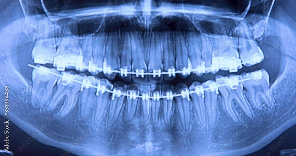 Vidéo Stock Dental xray with braces. Radiography for teeth
