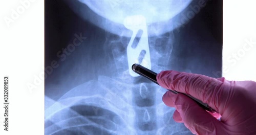 Doctor analyzing radiography of titanium plate fixation to support the cervical spine after C5 and C6 vertebrae injury. Provide neck stability using spinal instrumentation concept. Dolly shot 4k photo