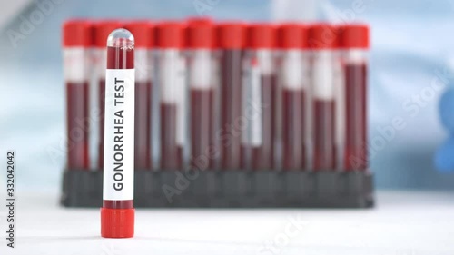 Hand wearing protection glove puts vial with gonorrhea test on the table