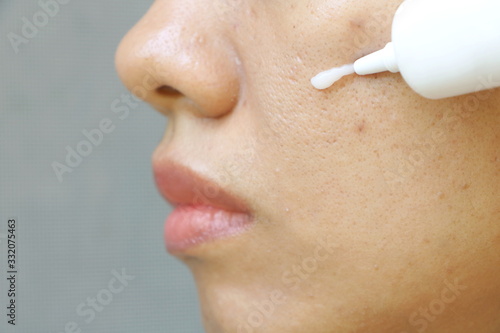 Close up Asian woman face have problem on skin, oily, large and wide pore. The woman use hand squeeze white cream in container to her cheek for facial care.