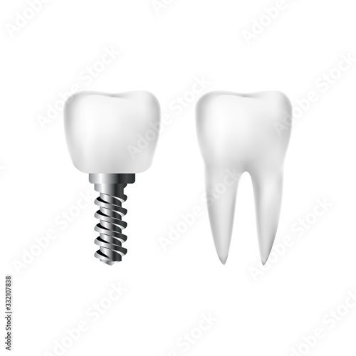 Realistic healthy white tooth and implant with screw. Dentistry and dentist care. Vector