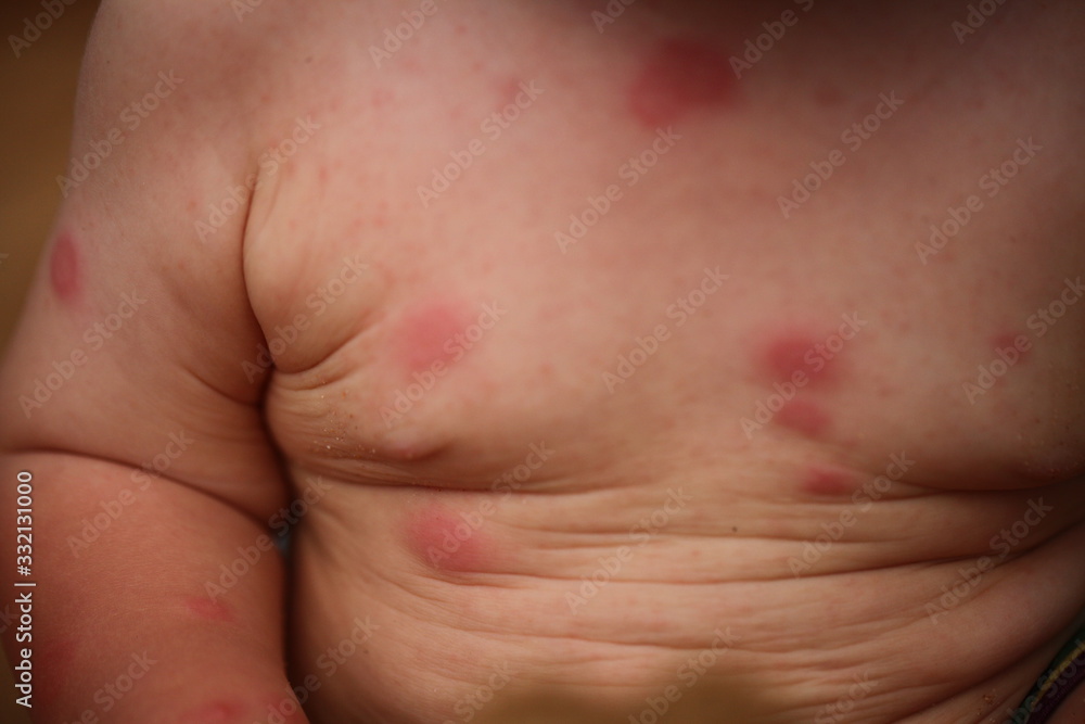 red spots disease allergy to the baby's body red spots disease allergy to the baby's body