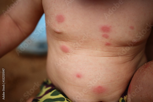 red spots disease allergy to the baby's body