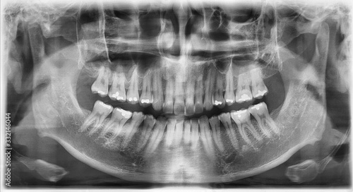 치아 치과 엑스레이 사진