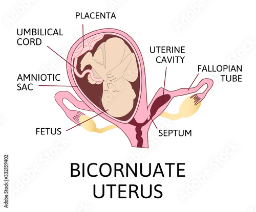 Bicornuate uterus and pregnancy. One uterine with fetus, child. Second uterine cavity is empty and separeted with septum.
