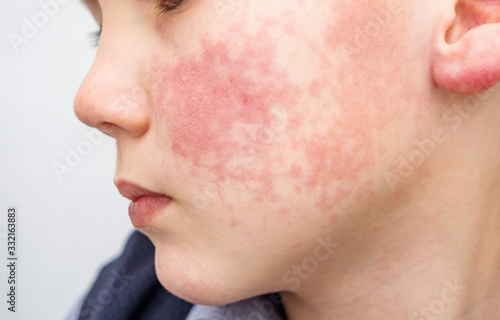 Boy with red cheeks- diathesis or allergy symptoms. Redness and peeling of the skin on the face.  photo