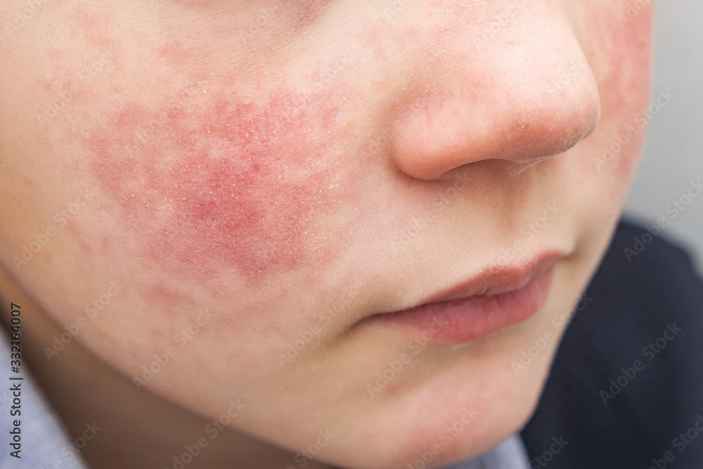 Boy with red cheeks diathesis or allergy symptoms. Redness and peeling