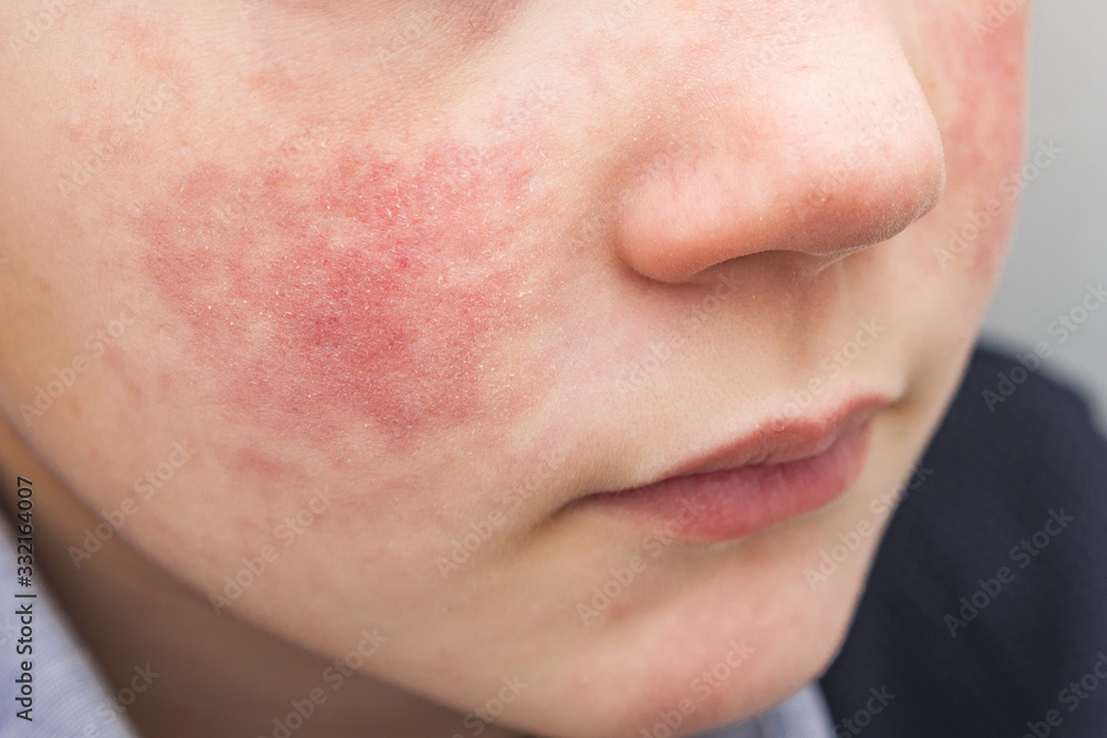 Boy with red cheeks- diathesis or allergy symptoms. Redness and peeling of  the skin on the face. Stock Photo | Adobe Stock