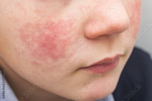 Boy with red cheeks- diathesis or allergy symptoms. Redness and peeling of the skin on the face.  photo