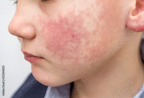 Boy with rosy red cheeks- diathesis, enterovirus infection or allergy symptoms. Redness and peeling of the skin on the face. 