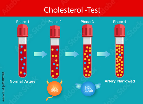 Cholesterol in artery, health risk , Levels of cholesterol, vector design