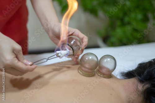 Acupuncture therapist putting a fire cupping glass from the back of a young woman photo