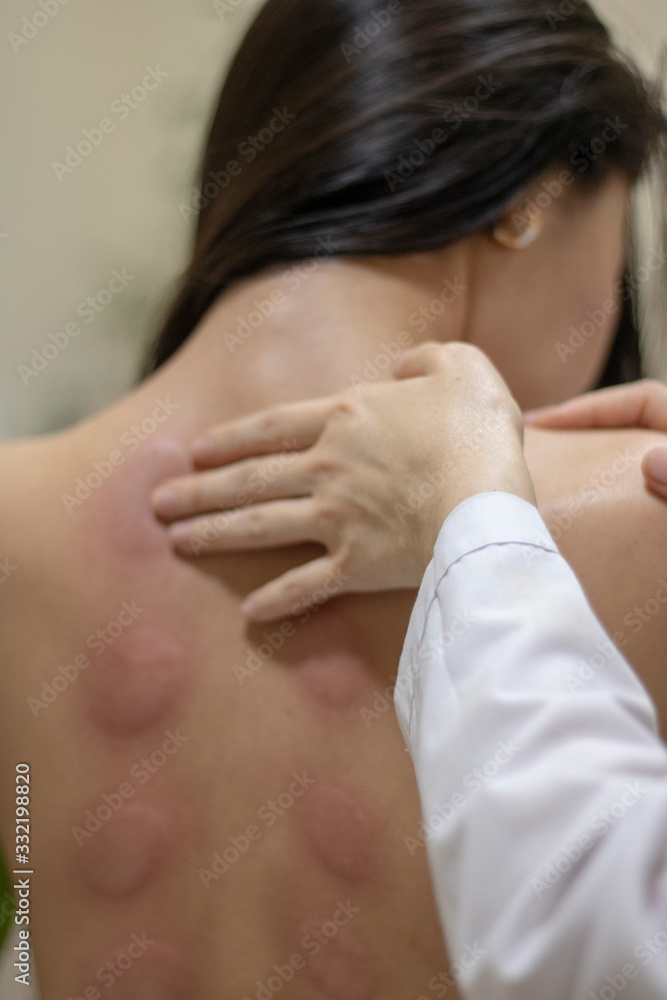asian Woman with traces of vacuum massage on her back asian Woman with traces of vacuum massage on her back