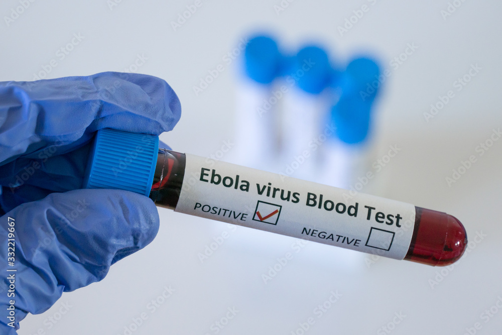 Obraz premium Positive blood test result for Ebola virus, Ebola virus disease (EVD)