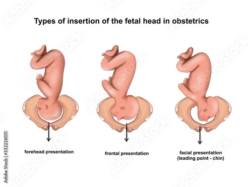 Illustration of the types of insertion of the fetal head in obstetrics