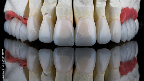 ceramic veneers and crowns of the upper jaw on a black background with a beautiful reflection on the glass
