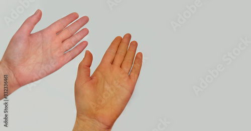 Jaundice sign. Yellowed palm beside the palm of normal color. Yellowing of the skin as the symptom of liver diseases.