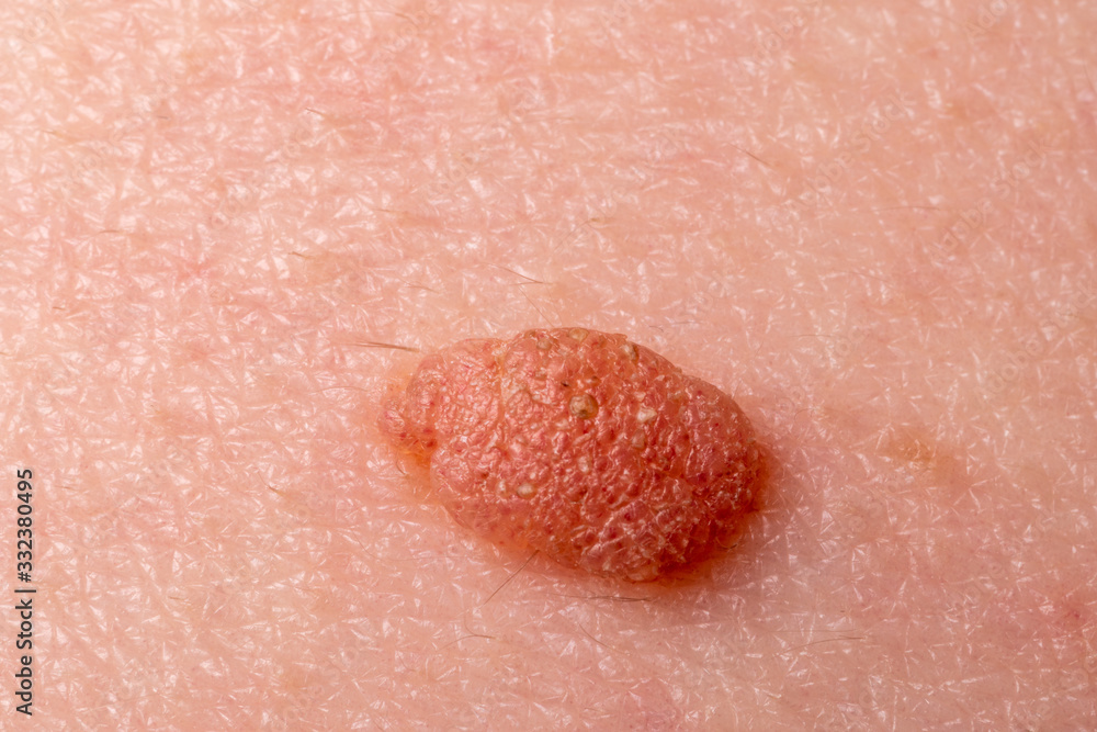 Fototapeta premium Large mole close-up. Macro shot of benign skin lesion on caucasian, human skin. Proliferation of pigment derma cells, melanocytic pigmented naevus, naevocytic nevus. Skin screening, cosmetic surgery