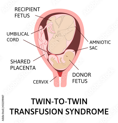 Twin-to-twin transfusion syndrome, feto-fetal transfusion syndrome. disproportionate blood supply. Two fetuses in womb, one bigger recipient, one smaller donor. pregnancy pathology.