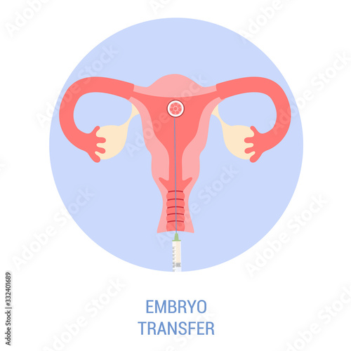 In vitro fertilisation step. Placing embryo into woman uterus.