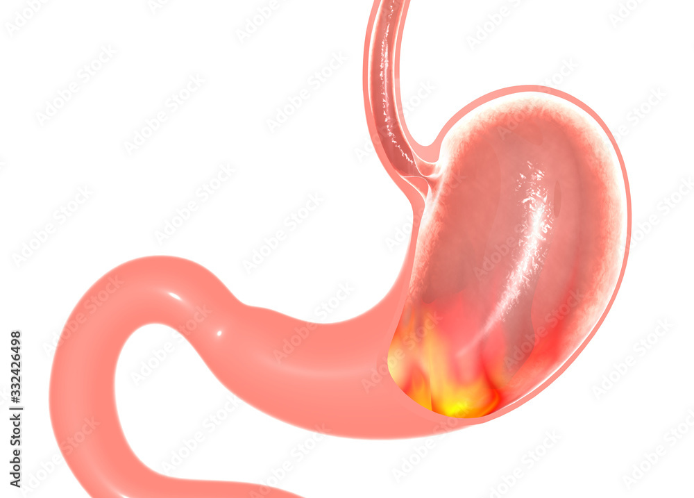 3D illustration of the internal anatomy of the stomach with heartburn and burning. Graphical representation of the hollow section with internal fire. 3D illustration of the internal anatomy of the stomach with heartburn and burning. Graphical representation of the hollow section with internal fire.