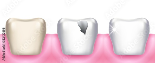 Teeth problems. Tooth decay, dental diseases, infection caries and enamel destruction. Professional clean or whitening. Realistic 3d stomatology vector illustration. Disease enamel, tooth decay